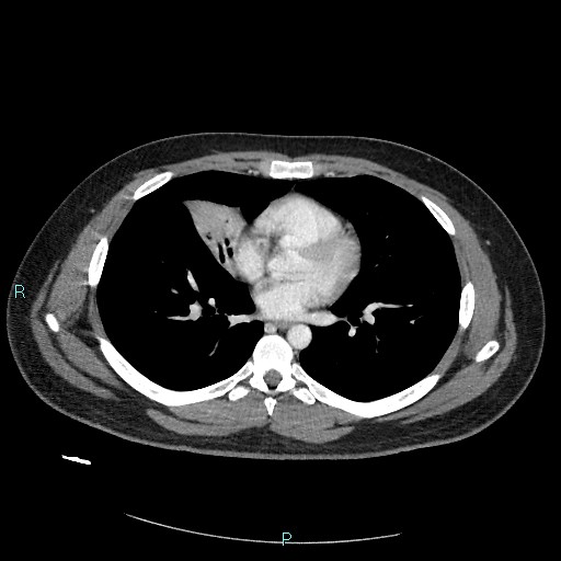 Bronchial carcinoid tumor (Radiopaedia 78272-90875 A 56).jpg