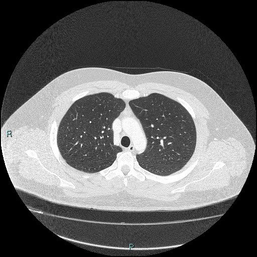 Bronchial carcinoid tumor (Radiopaedia 78272-90875 Axial lung window 13).jpg