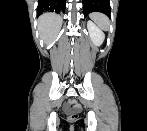Bronchiectasis in Crohn disease (Radiopaedia 60311-67977 C 70).jpg