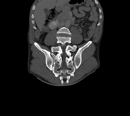 Bronchiectasis in Crohn disease (Radiopaedia 60311-67977 Coronal bone window 44).jpg
