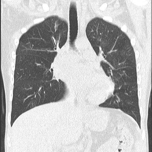 File:Bronchiolotis obliterans (Radiopaedia 73769-84575 Coronal lung window 19).jpg