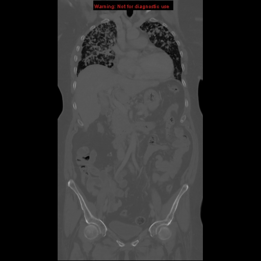 File:Bronchoalveolar carcinoma (Radiopaedia 13224-13233 Coronal non-contrast 2).jpg