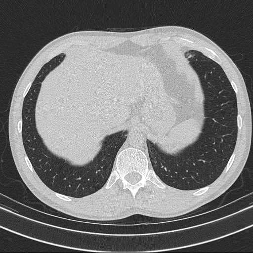 Bronchocele (Radiopaedia 60676-68429 Axial lung window 64).jpg