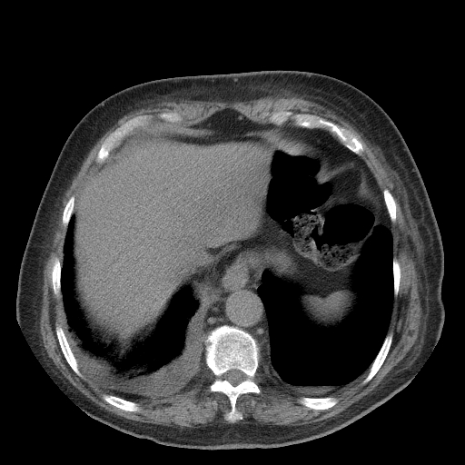 Bronchogenic carcinoma with metastatic lymphadenopathy (Radiopaedia 37671-39569 Axial non-contrast 46).jpg