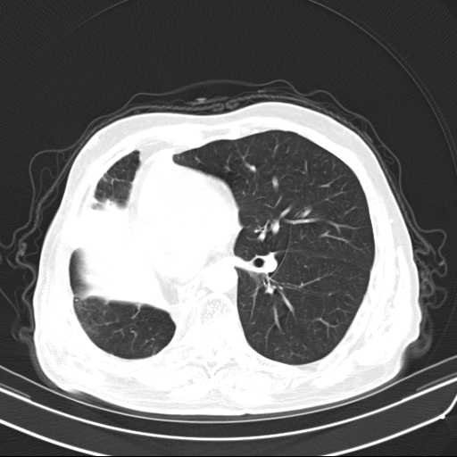 Bronchopleural fistula - postoperative complication (Radiopaedia 21020-20947 Axial lung window 32).jpg