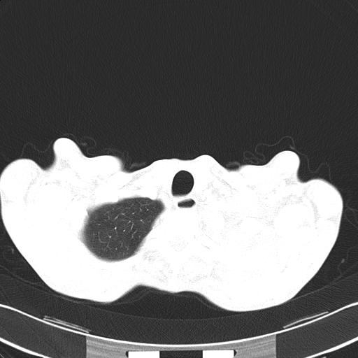 Bronchopleural fistula secondary to tuberculosis (Radiopaedia 20415-20322 Axial lung window 8).jpg