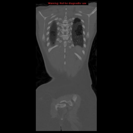 File:Brown tumor (Radiopaedia 12318-12596 D 57).jpg