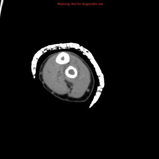 Brown tumor (Radiopaedia 12460-12694 Axial non-contrast 112).jpg