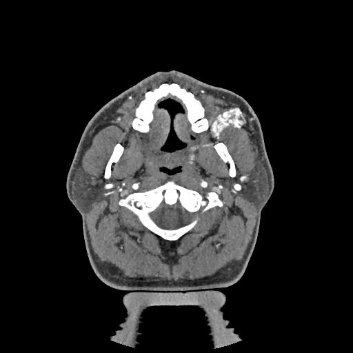 Buccal fat pad arteriovenous malformation (Radiopaedia 70936-81144 D 204).jpg
