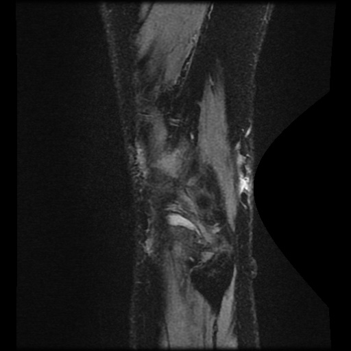Bucket handle meniscus tear (Radiopaedia 56916-63751 H 1).jpg