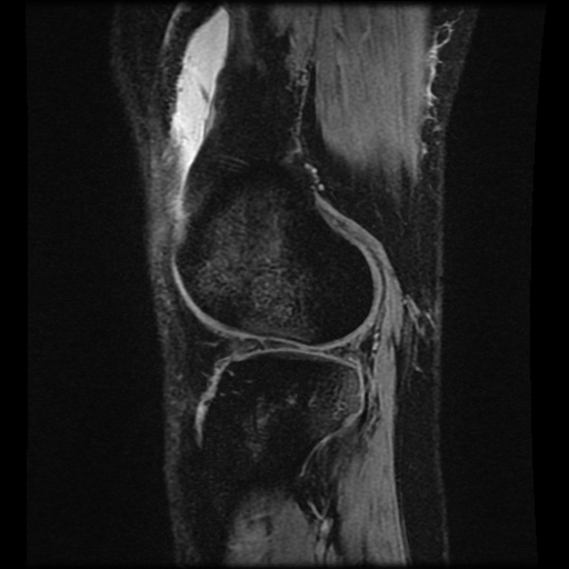 Bucket handle meniscus tear (Radiopaedia 56916-63751 H 17).jpg