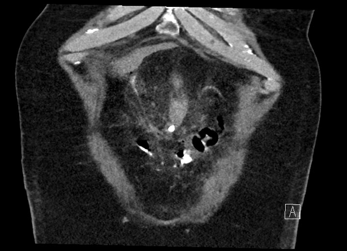 Buried bumper syndrome - gastrostomy tube (Radiopaedia 63843-72577 Coronal Inject 23).jpg