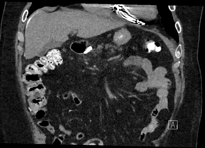 Buried bumper syndrome - gastrostomy tube (Radiopaedia 63843-72577 Coronal Inject 49).jpg