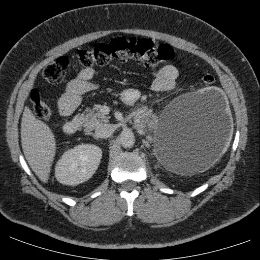 Burned-out testicular seminoma - retroperitoneal nodal metastases (Radiopaedia 62872-71245 A 27).jpg