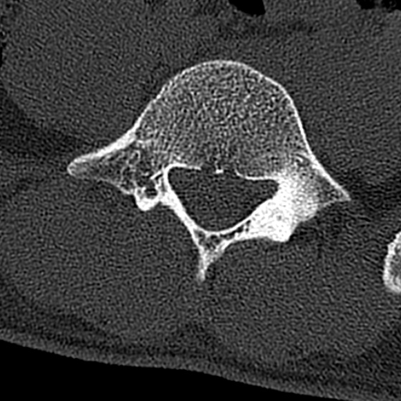 Burst fracture (Radiopaedia 53373-59357 Axial bone window 58).jpg