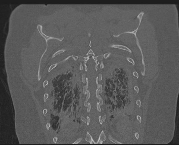 Burst fracture - thoracic spine (Radiopaedia 30238-30865 Coronal bone window 134).jpg