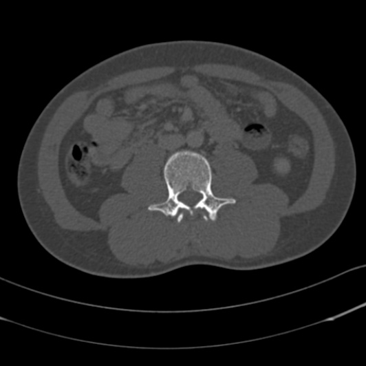 Burst fracture with cauda equina syndrome (Radiopaedia 25701-25867 Axial bone window 92).jpg
