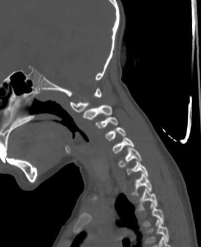 Butterfly vertebra (Radiopaedia 77903-90209 Sagittal bone window 24).jpg