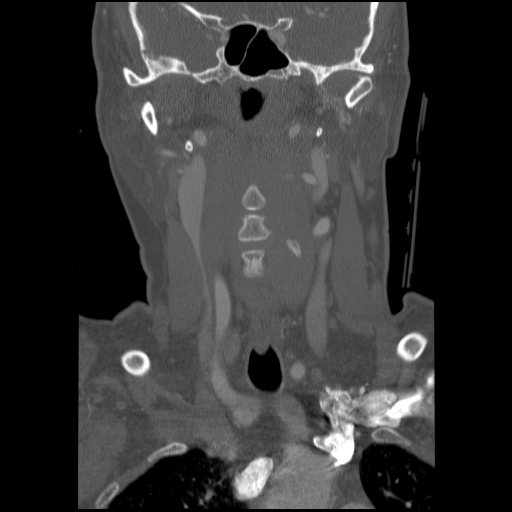 C1 anterior arch (plough) fracture - type 1 (Radiopaedia 76181-87720 Coronal bone window 66).jpg