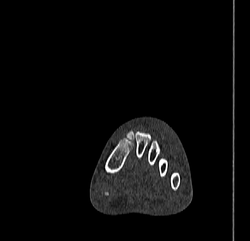 Calcaneal fracture - Sanders type 4 (Radiopaedia 90179-107370 Coronal bone window 35).jpg
