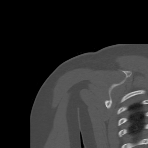 File:Calcific tendinitis of the infraspinatus tendon (Radiopaedia 87256-103539 Coronal bone window 46).jpg