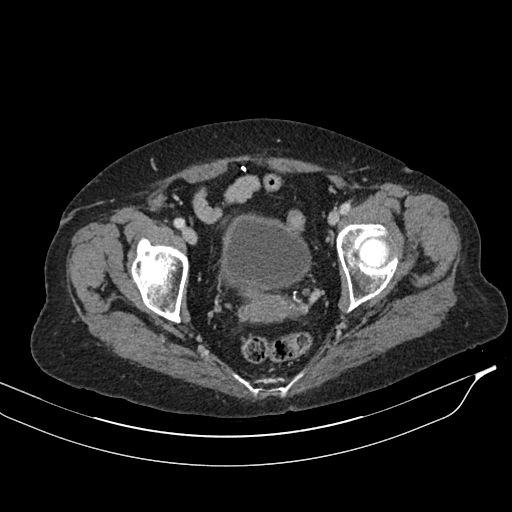 Calcified adrenal glands and Spigelian hernia (Radiopaedia 49741-54988 A 217).jpg