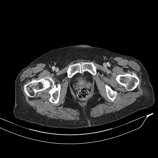 Calcified adrenal glands and Spigelian hernia (Radiopaedia 49741-54988 A 245).jpg