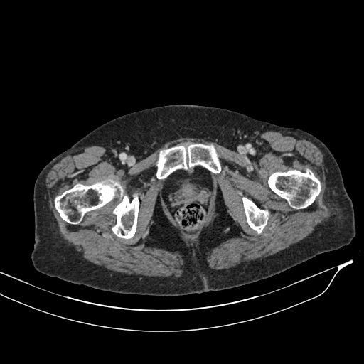Calcified adrenal glands and Spigelian hernia (Radiopaedia 49741-54988 A 246).jpg