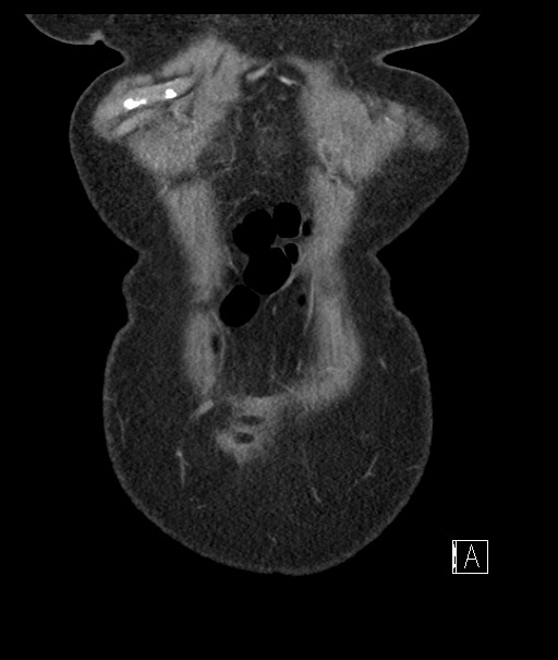Calcified adrenal glands and Spigelian hernia (Radiopaedia 49741-54988 B 10).jpg