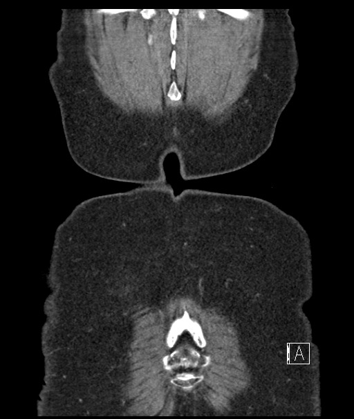 Calcified adrenal glands and Spigelian hernia (Radiopaedia 49741-54988 B 114).jpg
