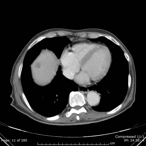 Calcified liver metastases (Radiopaedia 44699-48470 B 4).jpg