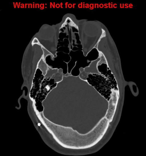 Calvarial thickening from chronic shunting (Radiopaedia 60079-67637 Axial bone window 50).jpg