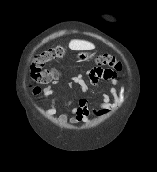 Cannonball metastases from endometrial cancer (Radiopaedia 42003-45031 F 13).png