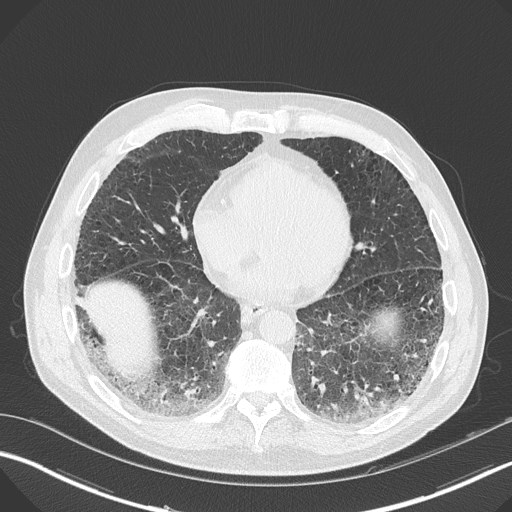 Caplan syndrome (Radiopaedia 56667-63530 Axial lung window 133).jpg