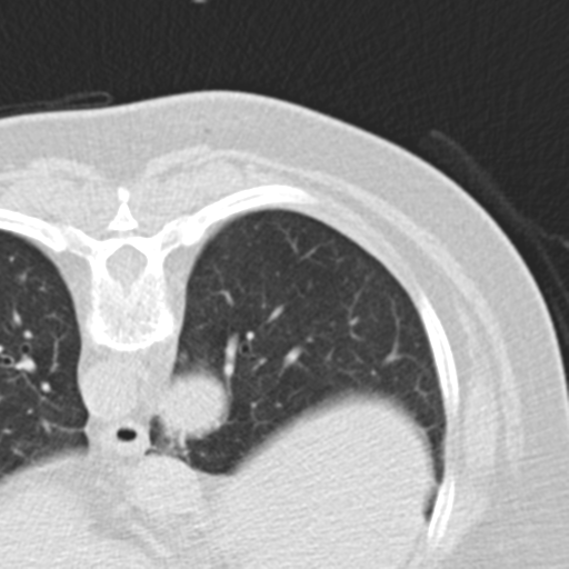 File:Carcinoid tumor - lung (Radiopaedia 44814-48644 Axial lung window 50).png