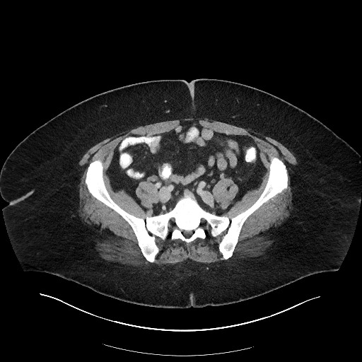 Carcinoid tumor - terminal ileum (Radiopaedia 60931-68739 A 95).jpg