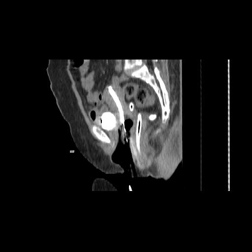 File:Carcinoma cervix- brachytherapy applicator (Radiopaedia 33135-34173 D 85).jpg