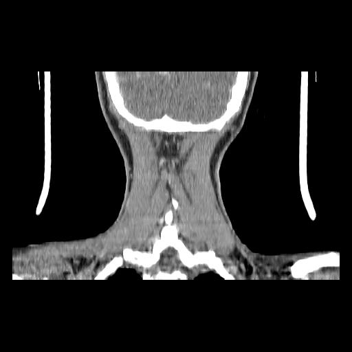 Carcinoma of the maxillary antrum (Radiopaedia 53805-59888 Coronal C+ delayed 147).jpg