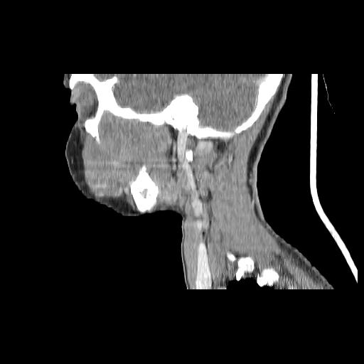 Carcinoma of the maxillary antrum (Radiopaedia 53805-59888 Sagittal C+ delayed 52).jpg