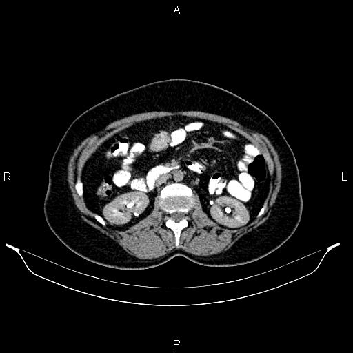 File:Carcinoma of uterine cervix (Radiopaedia 85861-101700 Axial C+ delayed 29).jpg