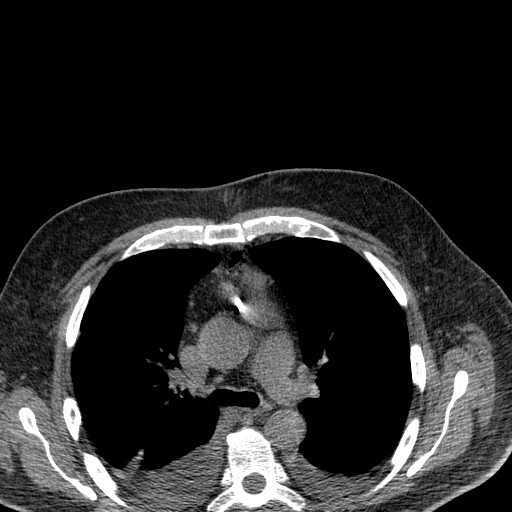 File:Cardiac lymphoma (Radiopaedia 38690-40840 Axial non-contrast 2).jpg