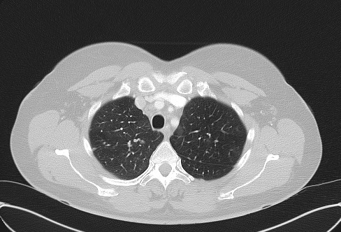 File:Cardiac sarcoidosis (Radiopaedia 74548-85534 Axial lung window 17).jpg