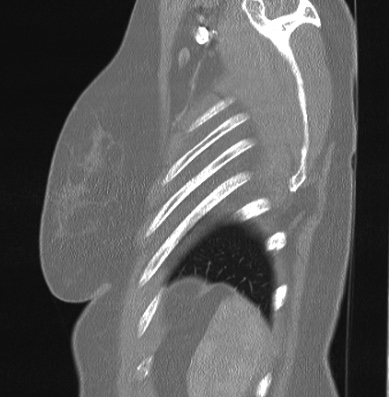 Cardiac sarcoidosis (Radiopaedia 74548-85534 Sagittal lung window 6).jpg