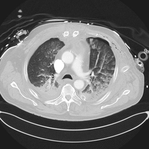 Cardiac trauma (Radiopaedia 32874-33858 Axial lung window 20).jpg