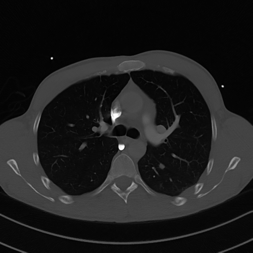 Cardiac tumor - undifferentiated pleomorphic sarcoma (Radiopaedia 45844-50134 Axial bone window 26).png