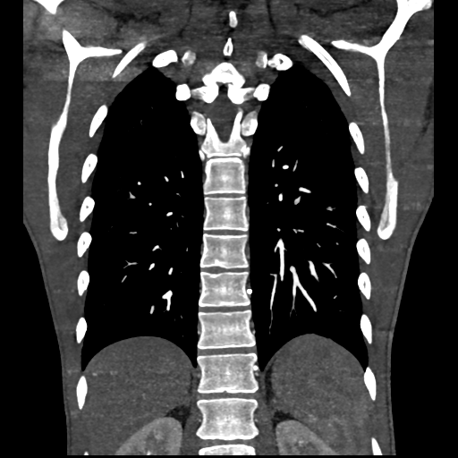 Cardiac tumor - undifferentiated pleomorphic sarcoma (Radiopaedia 45844-50134 Coronal non-contrast 55).png