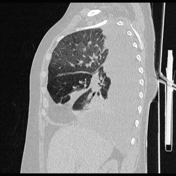 Cardiogenic pulmonary edema (Radiopaedia 29213-29609 Sagittal lung window 31).jpg