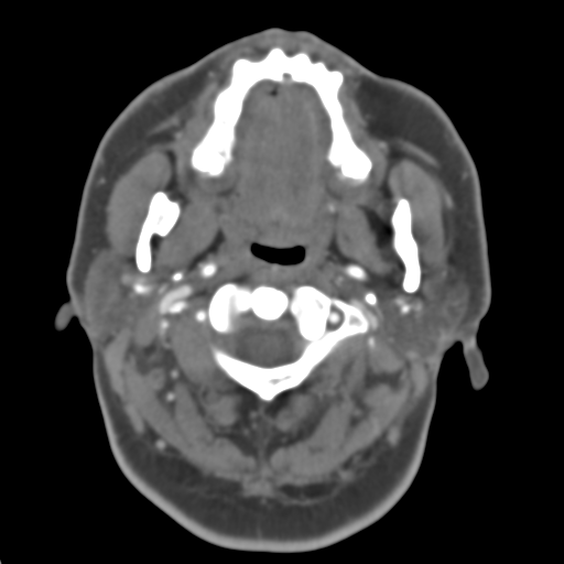 Carotico ophthalmic aneurysm (Radiopaedia 42916-46148 A 53).png