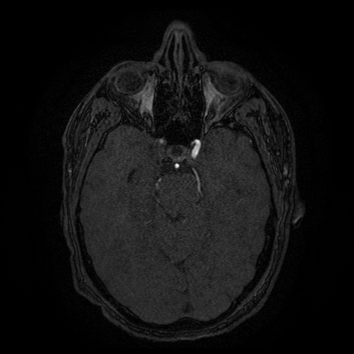 Carotid arterial dissection with acute cerebral infarction (Radiopaedia 26636-26784 MRA 109).jpg