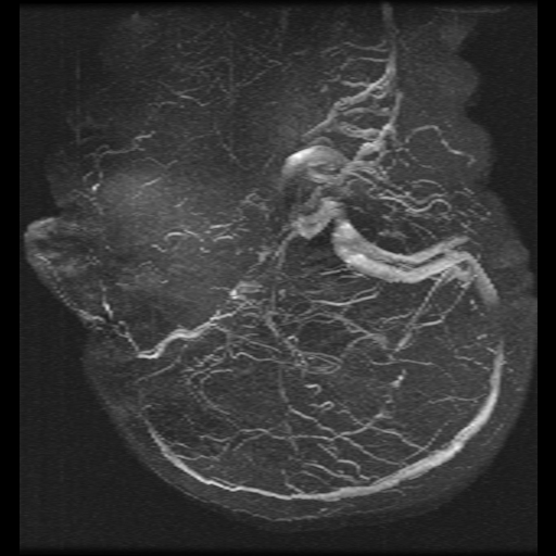 Carotid arterial dissection with acute cerebral infarction (Radiopaedia 26636-26784 MRV 20).jpg